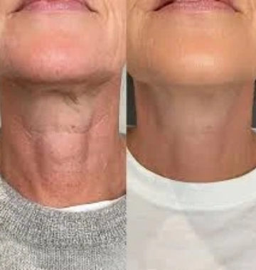 How to tighten neck skin?